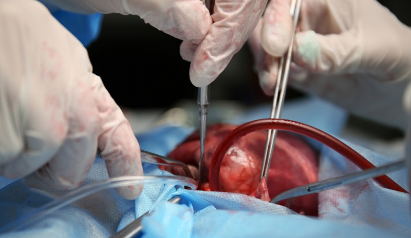 In besonders schweren Fällen ist eine Herztransplantation notwendig.