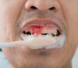 Schlaganfall durch Zahnfleischentzündungen: Risikofaktor schon für jüngere Menschen ( Foto: Shutterstock-AOM Zaaom )