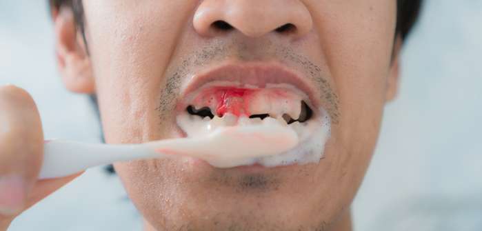Schlaganfall durch Zahnfleischentzündungen: Risikofaktor schon für jüngere Menschen ( Foto: Shutterstock-AOM Zaaom )