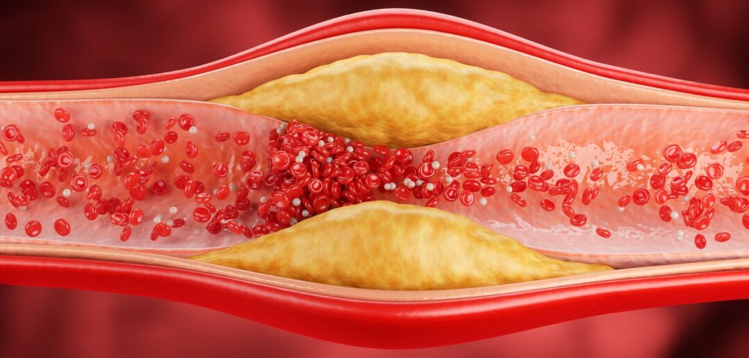 Atherosklerose und Schlaganfall: Neue Erkenntnisse aus der Gefäßforschung (Foto: AdobeStock - Anusorn - 1713944678)