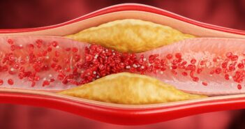 Atherosklerose und Schlaganfall: Neue Erkenntnisse aus der Gefäßforschung (Foto: AdobeStock - Anusorn - 1713944678)